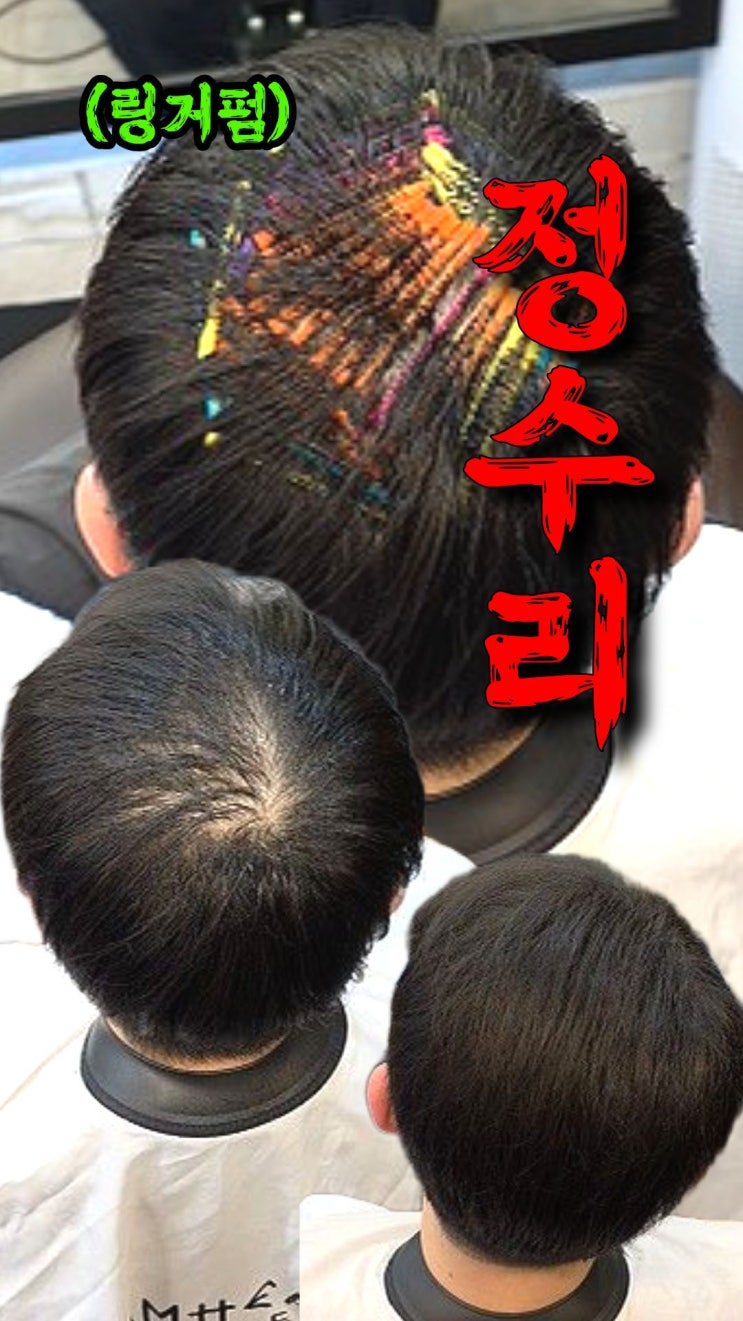  성성동 정수리 탈모 고민, 수원까지 찾게 만든 링거펌 후기