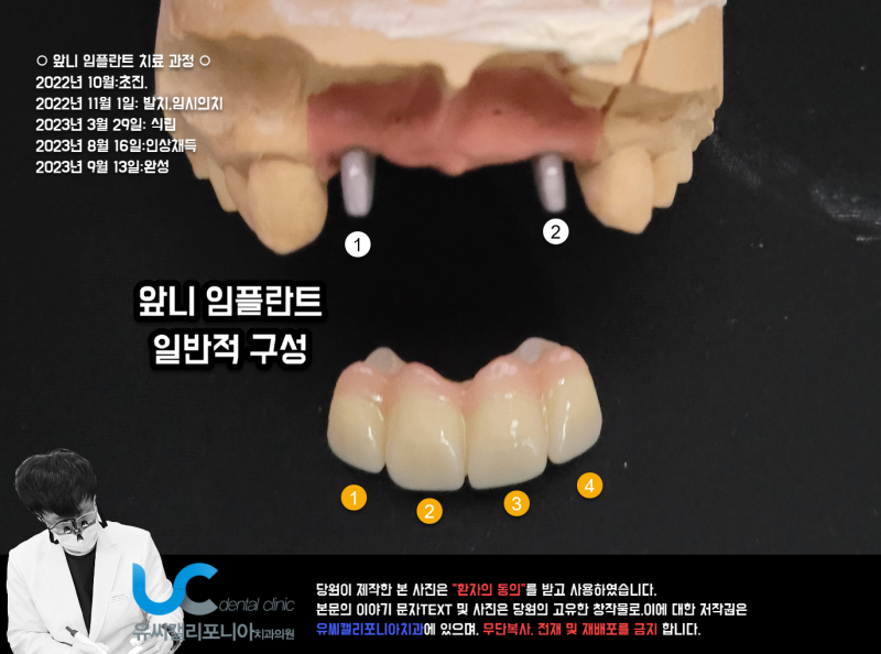 앞니임플란트 개수와 브릿지 하중 연구 몇개식립이 좋을까?