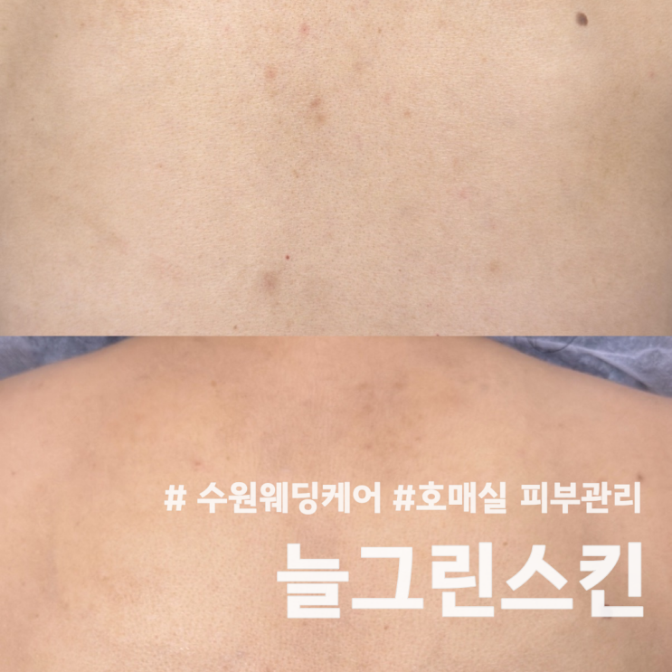  [수원/권선구] 수원웨딩케어 늘그린스킨 호매실 피부관리 등필링 후기