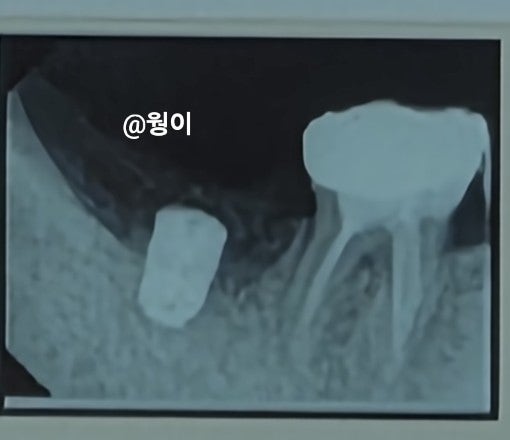 30대 재식술 실패 ️ <b>임플란트</b> 후기 2탄
