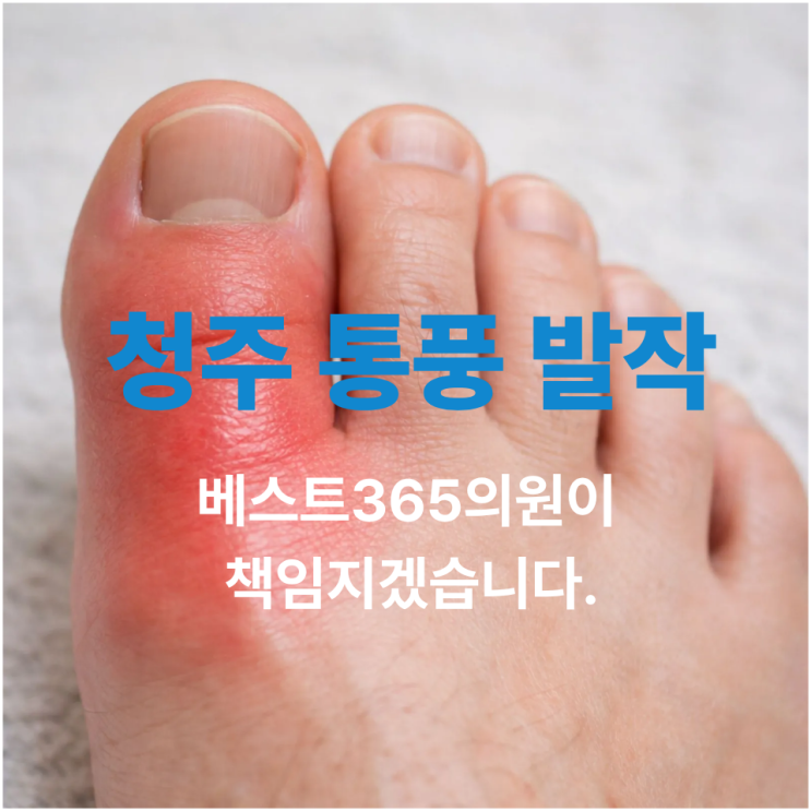  청주 통풍 발작 초기증상,어떤 약을 언제 먹어야 치료 될까요?