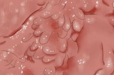 여자 곤지름 증상, 원인,치료까지 이거모르면 손해