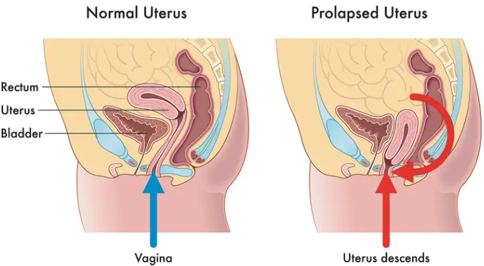 밑이 빠지는 듯한 묵직한 하복부 통증과 압박감이 느껴질 때 자궁탈출증 원인 및 증상, 검사....