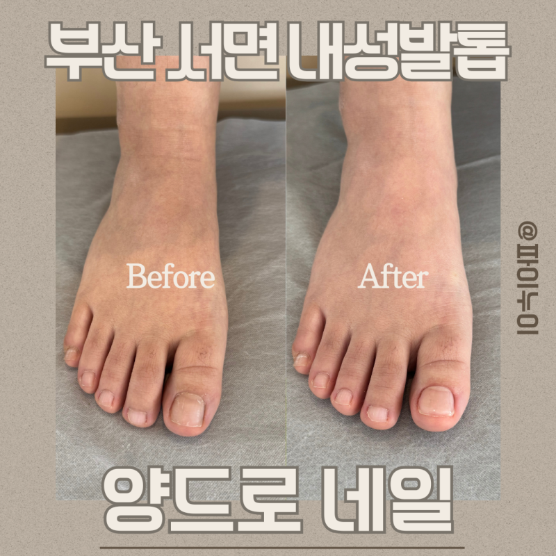 부산서면내성발톱 C커브 발톱 관리 제대로 받은 양드로네일