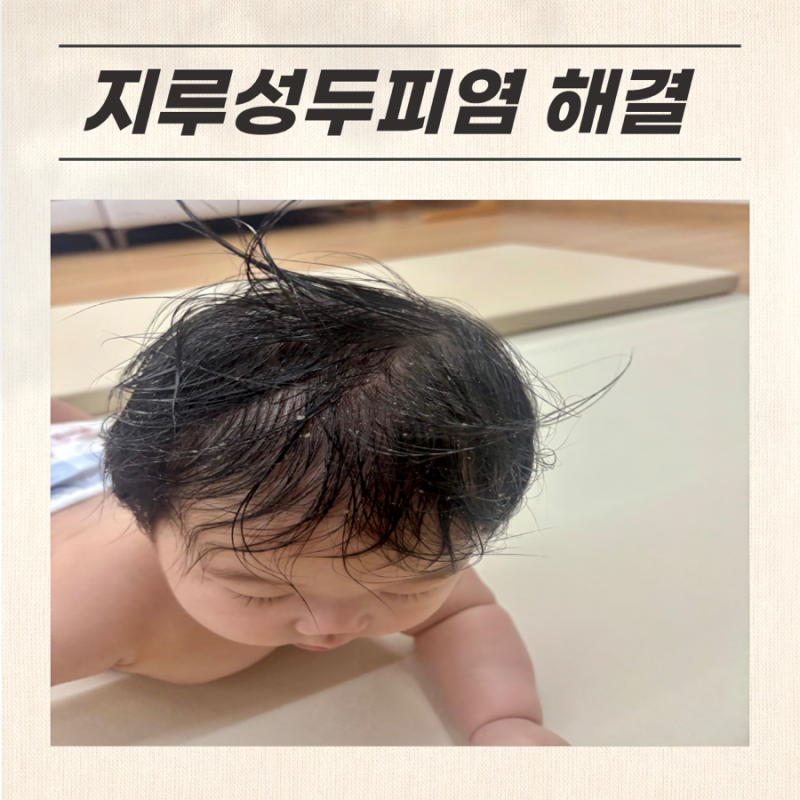 아기 지루성두피염 병원 다녀온 후기 (7개월 아기 관리법 & 오일 사용방법)