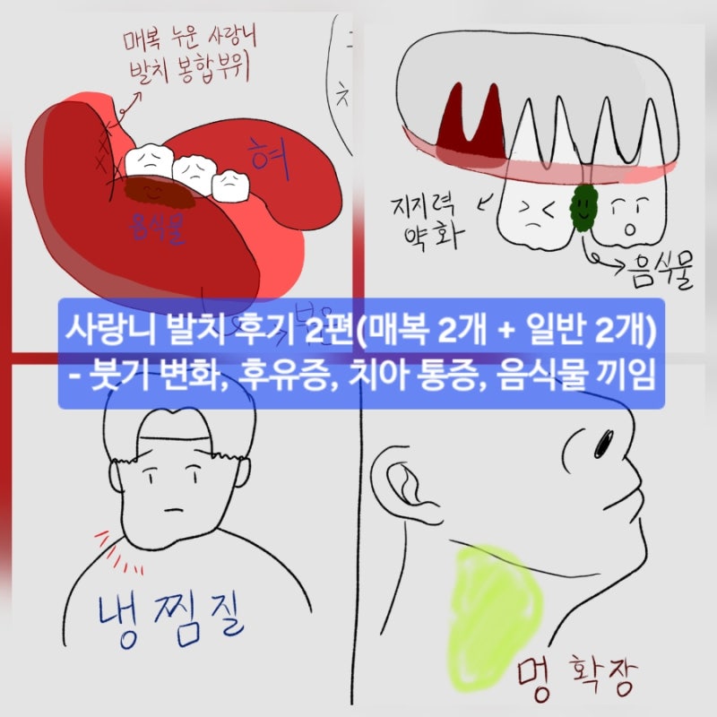 사랑니 4개 발치 후기 2편 | 후유증, 붓기 변화, 치아통증, 음식물 낌 [매일운동 285일차]
