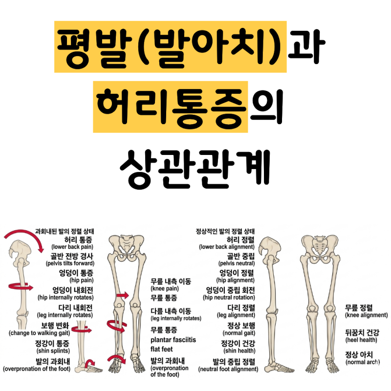 허리통증과 발 과회내(pronation)(평발) 사이의 관계 – 발아치가 무너지면 허리가 아픕니다
