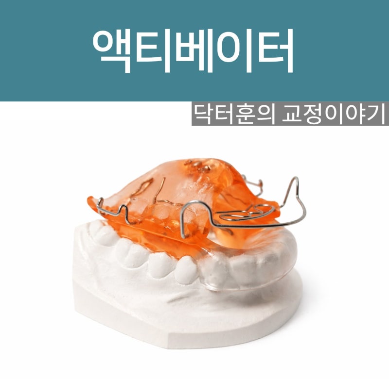 무턱(II급, 2급) 성장기 교정치료: 액티베이터(Activator)? 기능성 교정장치(Functional appliance)? 프....