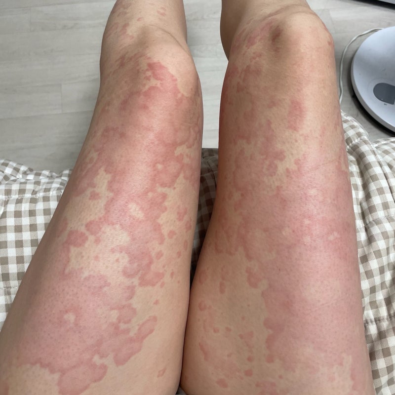 급성 두드러기 증상 발현 4일차 및 치료 경과+피부묘기증 왜 나에게 이런 일이