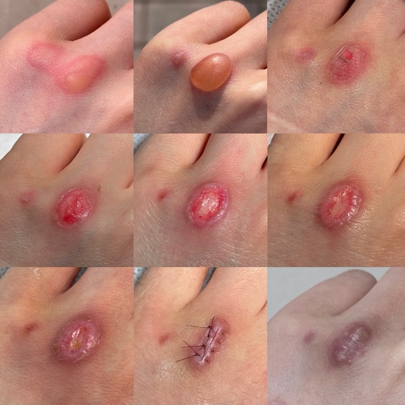 핫팩 저온화상으로 치료에서 수술까지♨️(심재성 2도화상, 가피절제술, 치료비, 화상보험금....
