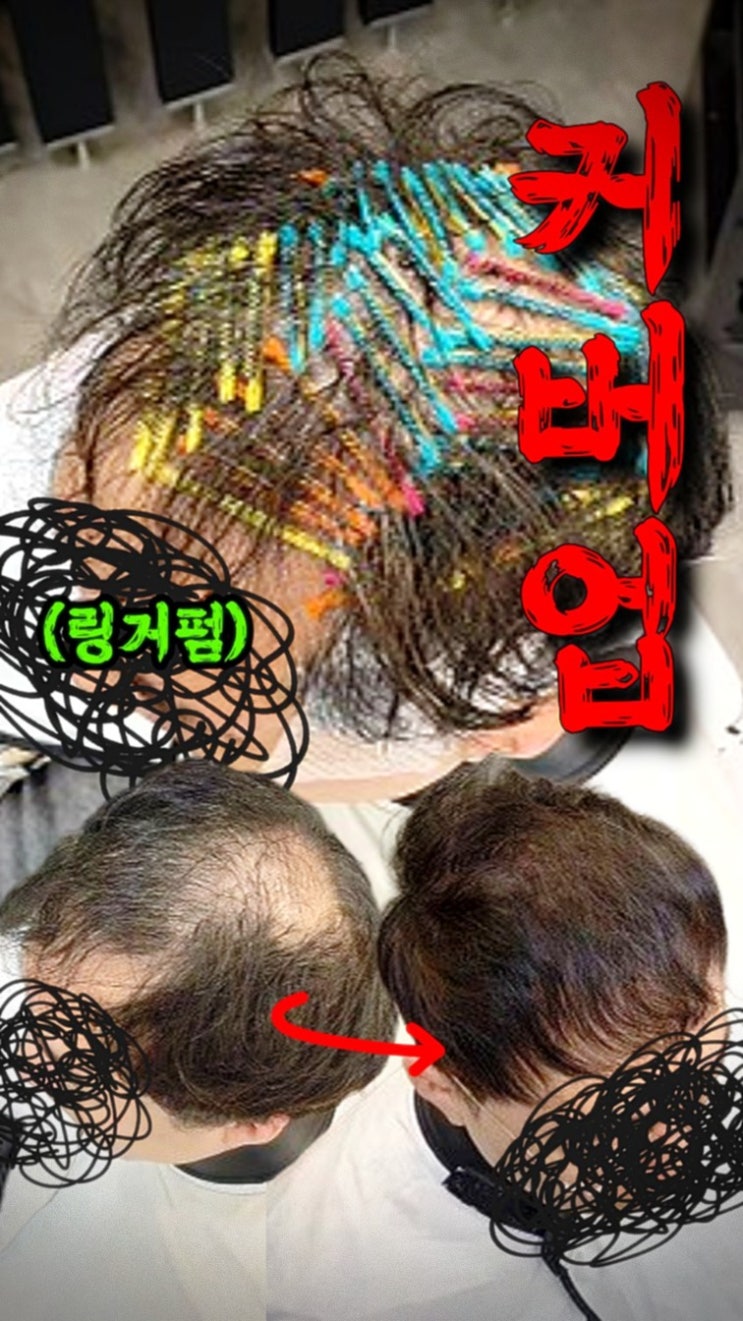  과천 링거펌 찾다가 수원까지 온 이유, 정수리 탈모 해결 후기