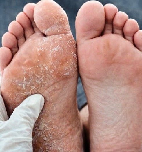 지긋지긋한 무좀, 이제 안녕..최신 치료법부터 재발 방지 방법까지
