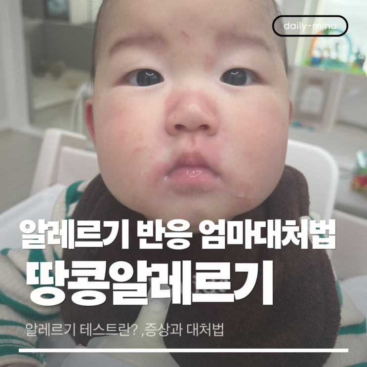  이유식 알레르기 테스트란? 8개월 아기 땅콩알레르기,엄마시선에서 본 대처 가이드