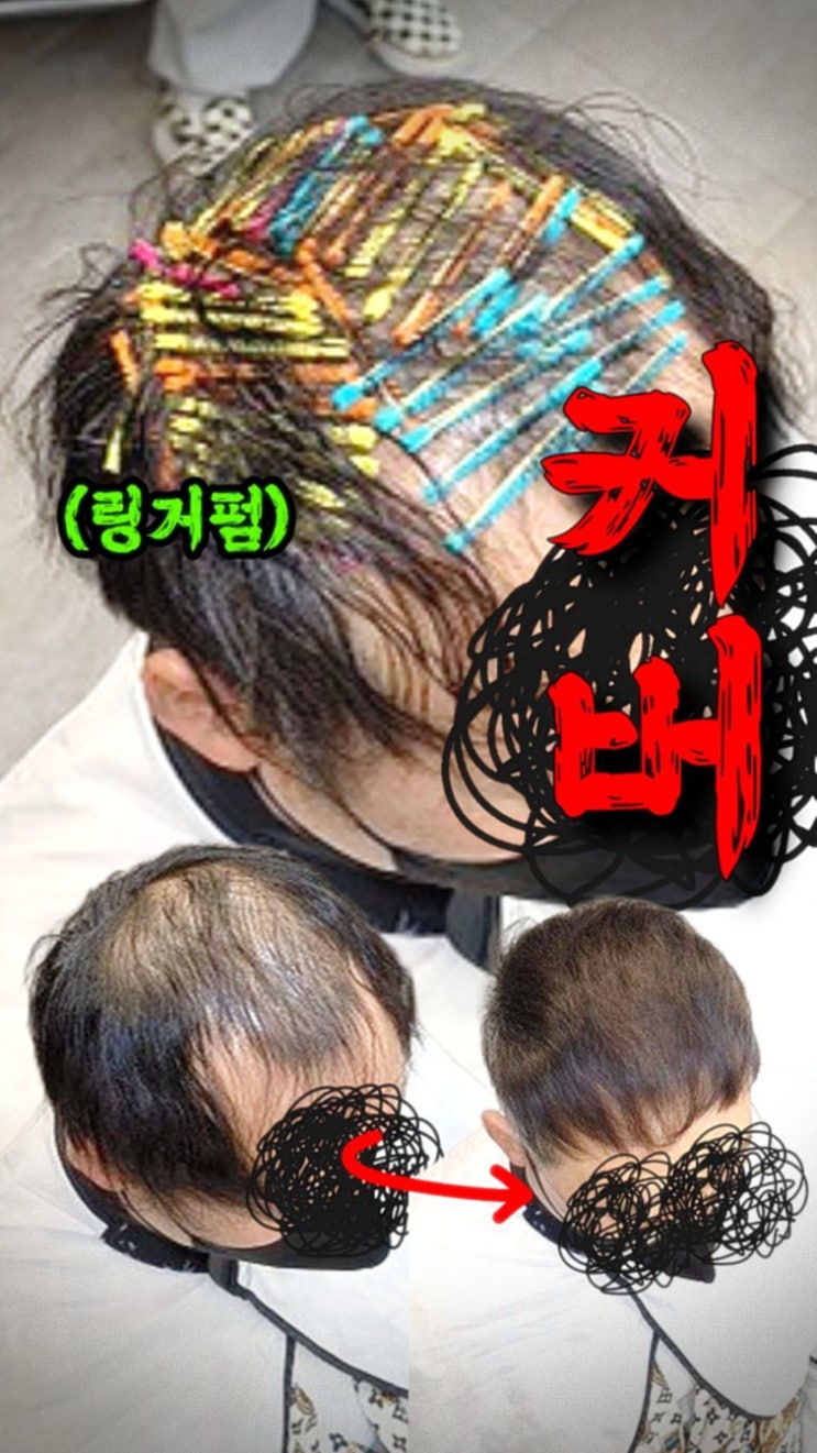  안양 링거펌 찾다가 수원 방문! 50대 남성 탈모 펌 리얼 후기