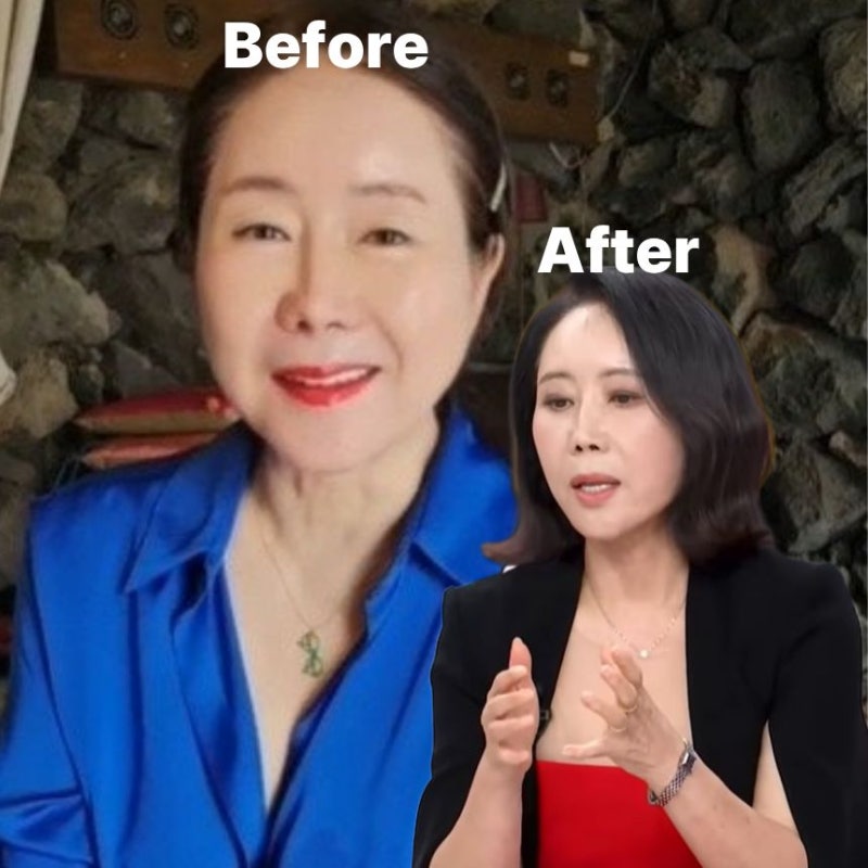 “안면 거상 효과 이정도야?” 윤영미 64세에 찾은 미친 미모, 안면 거상 비용보다 놀라운 유....
