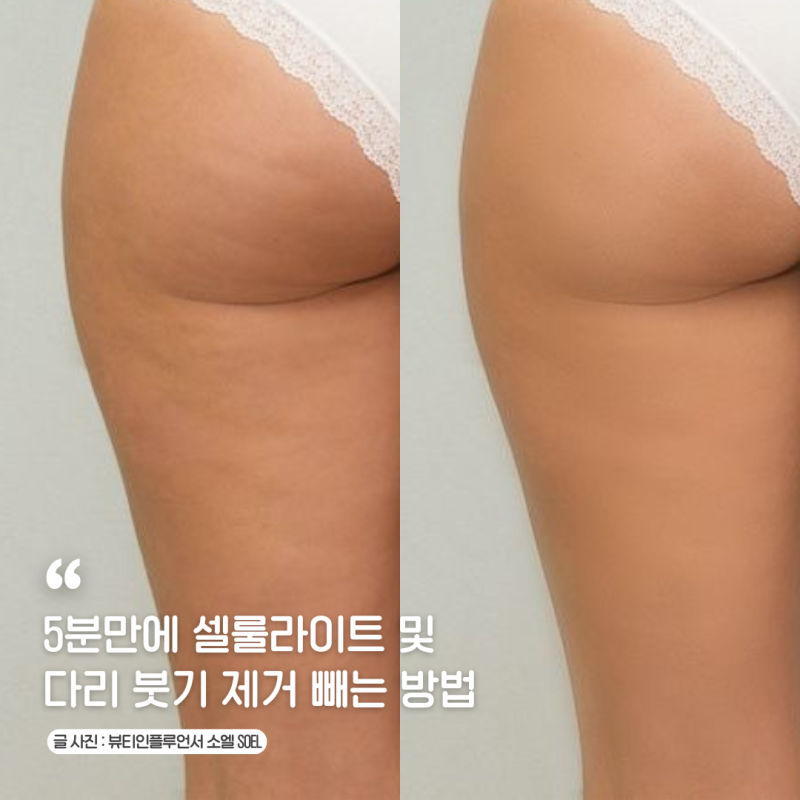 오일 크림 리프팅 롤러 마사지기 바디스핀을 이용한 셀룰라이트 및 다리 붓기 제거 빼는 방....