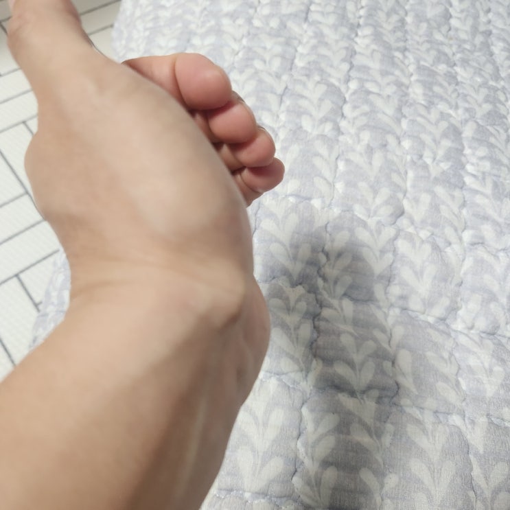  손목에 갑자기 생긴 혹, 이거 뭐지? 결절종 원인부터 치료법까지 총정리!
