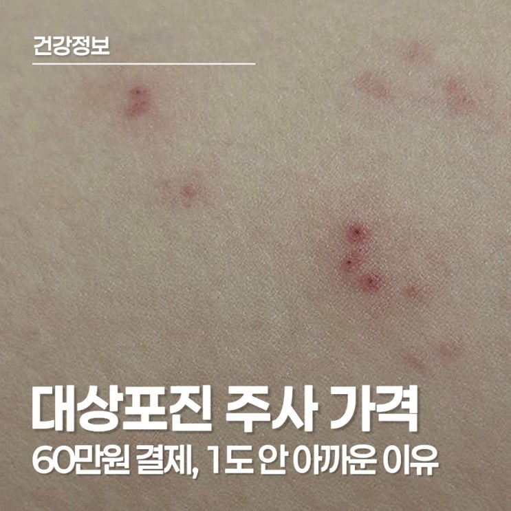  대상포진 주사 가격, 사백신은 왜 비쌀까? 2회 접종 비용이 아깝지 않은 이유