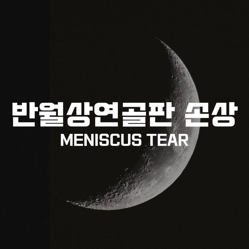 반월상연골판 손상, 꼭 수술해야 할까? 수술을 해야하는 기준