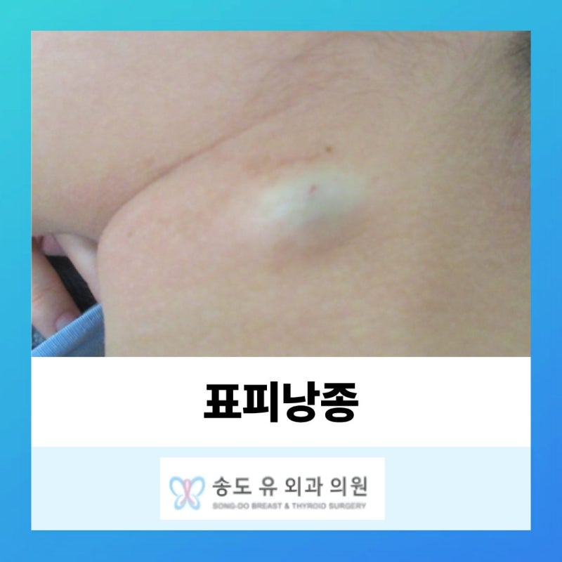 인천 송도 표피낭종(피지낭종) 원인과 치료법 정리