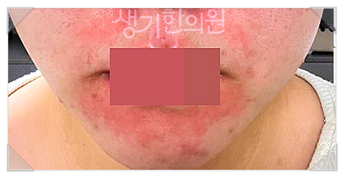 안면 지루성피부염 각질, 홍조, 붉어짐 증상, 반복된다면 ‘이 변화’부터 체크하세요