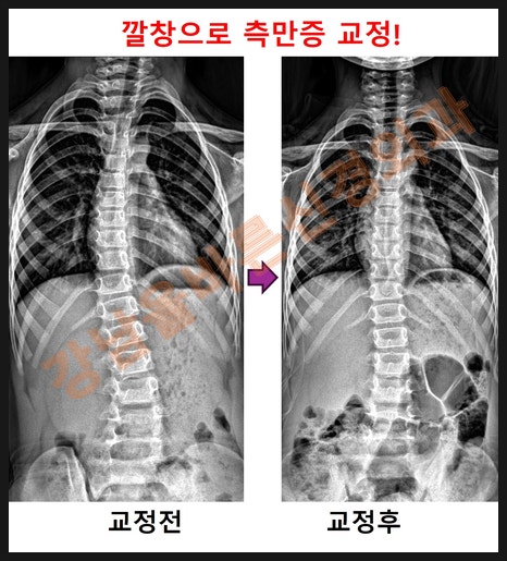 초등학생 척추측만증! 보조기 없이 평발용깔창으로 교정이 가능할까?