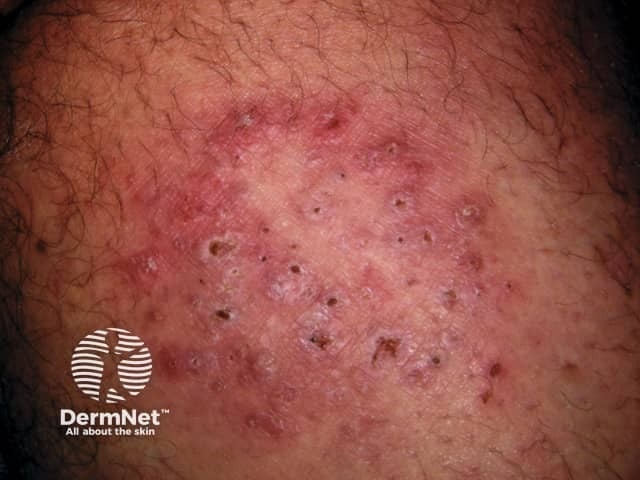 백선균성 육아종, 일반 백선이랑 달라요❌ 연고 발라도 절대 안 낫네 이거 대체 뭐길래?