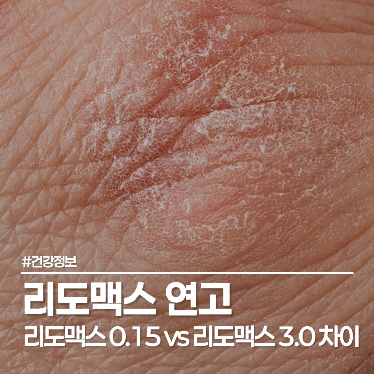  리도맥스 연고 0.15 vs 0.3 차이점, 스테로이드 등급과 보습 꿀팁