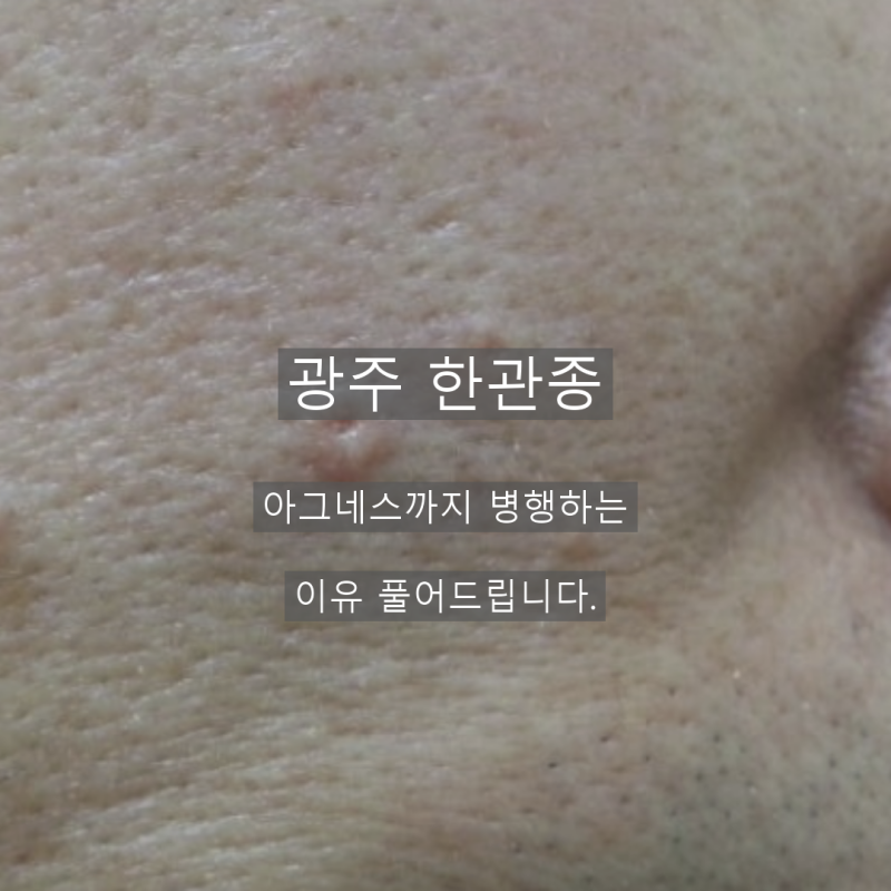 광주 한관종 아그네스까지 병행하는 이유 풀어드립니다.
