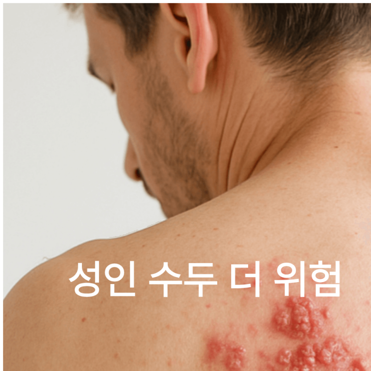  청주 처음엔 알러지? 알고 보니 성인 수두… 주말진료에서 발견된 실제 사례