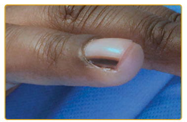 흑색조갑증 (Longitudinal melanonychia) (1)