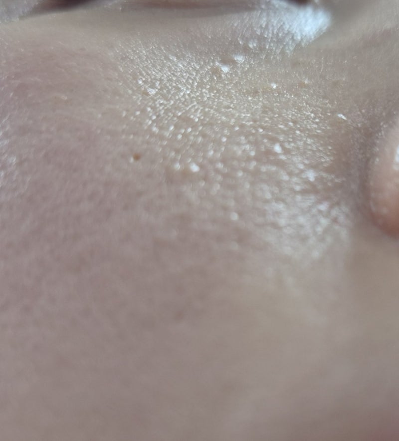 편평사마귀 거우침으로 치료받은 후기(1)