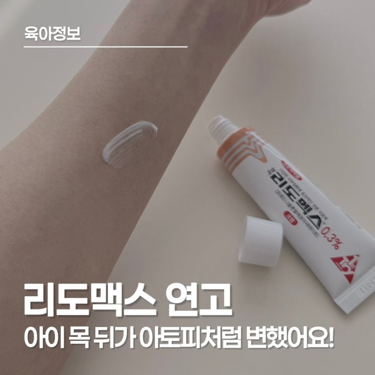  리도맥스 연고, 아기 얼굴 침독에 무작정 바르기 전 확인할 것들