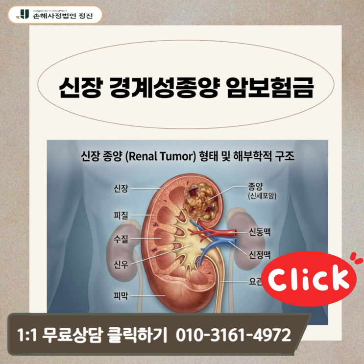  신장 경계성종양 암보험금, D41.0 코드라도 전액 지급받는 비결은?