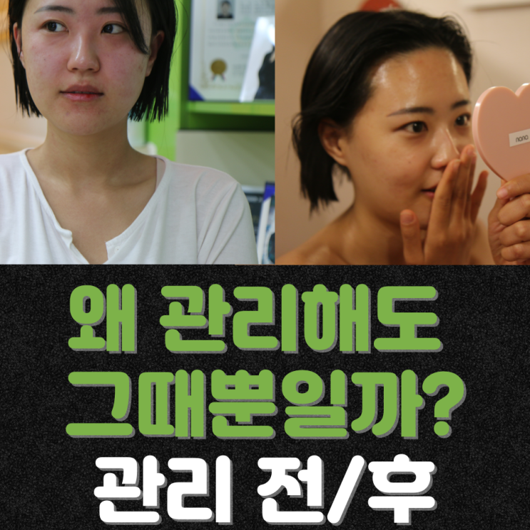 붓기 방치가 부종 얼굴 라인을 바꾼다? 성성동 쑥뜸관리로 시작하는 웰니스 피부관리