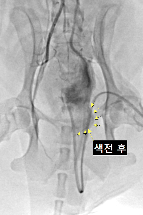 해당 환자의 C-ARM을 통한 전립선 동맥색전술 시술 이미지