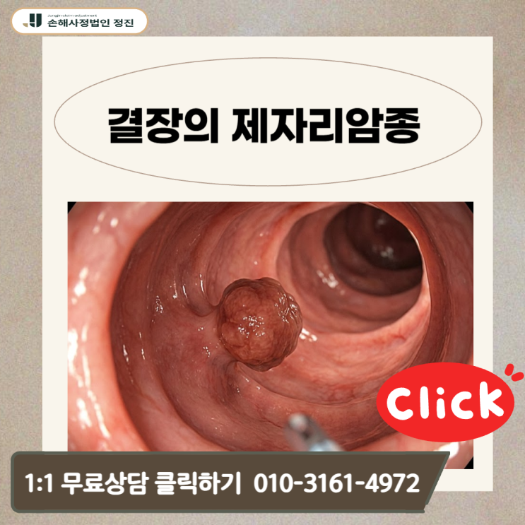  결장의 제자리암종 암보험금, D01.0인데도 전액 받은 실제 사례