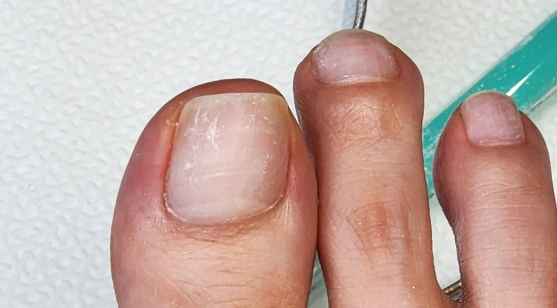 인천내성발톱병원 문제성발톱 치료 추천