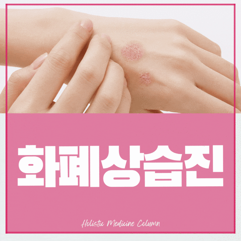 화폐상습진 연고, 비판텐 선택이 좋을까? 치료 기준과 한의원 음식관리