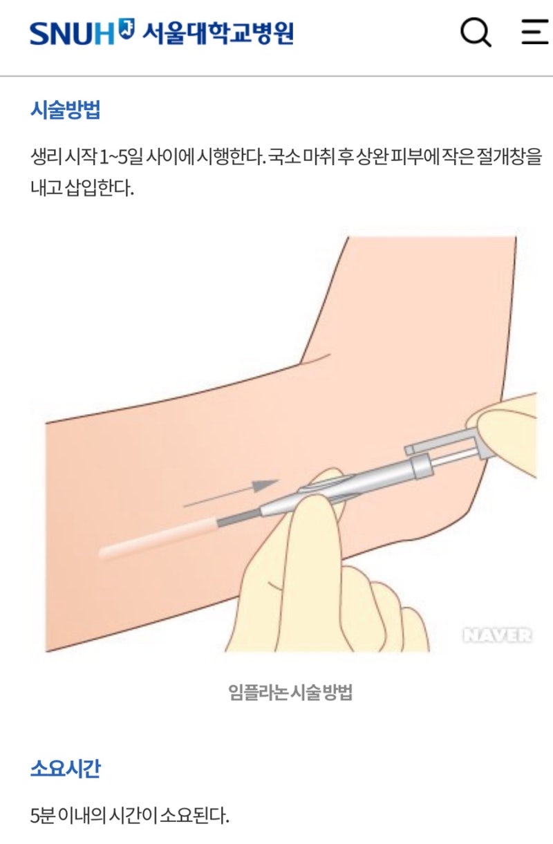 임플라논 2년 차 후기