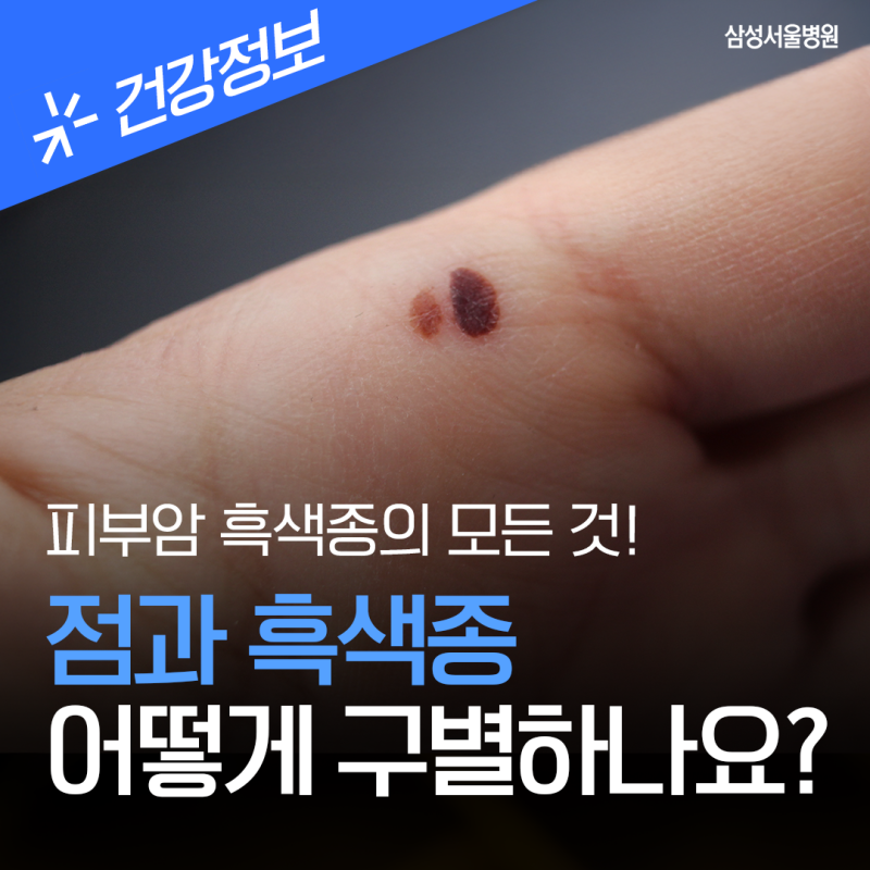 점과 흑색종을 어떻게 구별하나요? 흑색종 구별법부터 치료 과정 총정리 / 삼성서울병원 성....