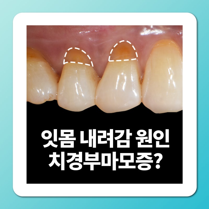 잇몸 내려감 치경부마모증 원인 레진 GI 비용 과정