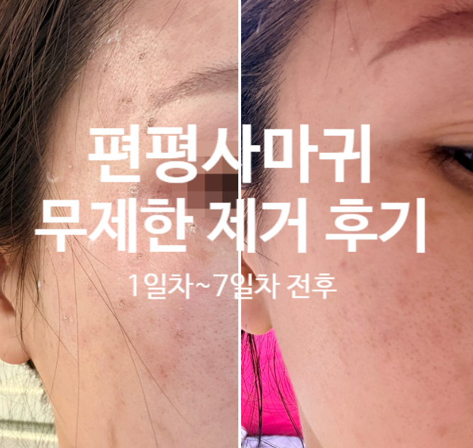 편평사마귀 제거 후기 1일차~7일차 전후 비교(듀오덤X)
