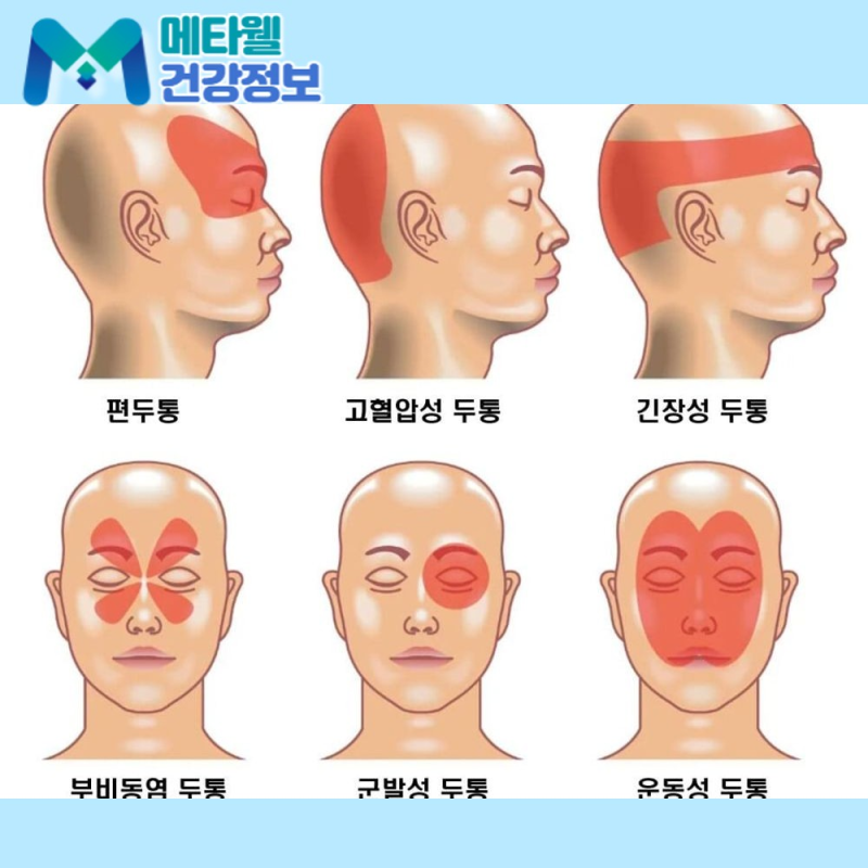 오른쪽 왼쪽 편두통이 다르다고? 원인과 증상, 심할 때 대처법까지