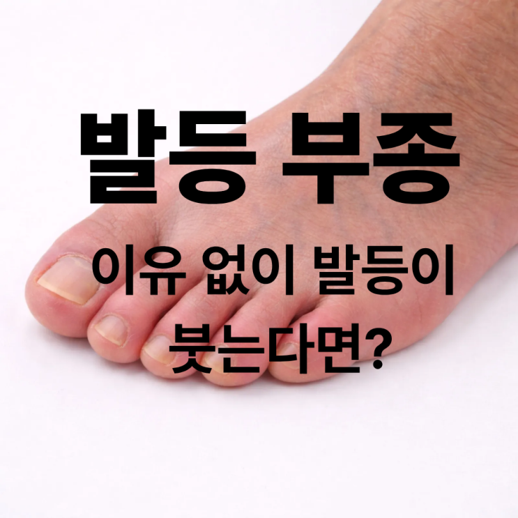  이유 없이 발등이 붓는다면?