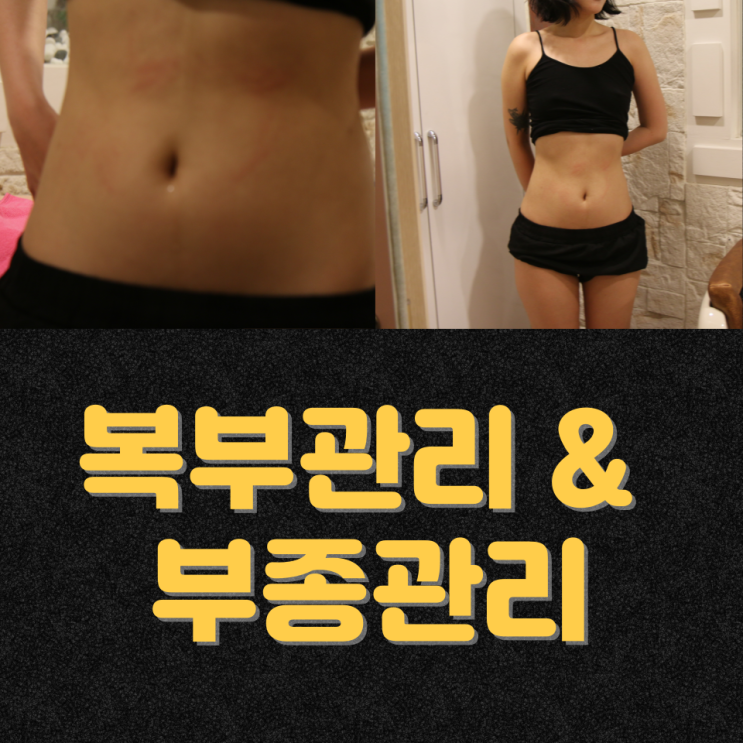  천안 신부동다이어트 살빼기 전 체중감량과 하체관리를 위한 쑥뜸 부종관리를 하는 이유
