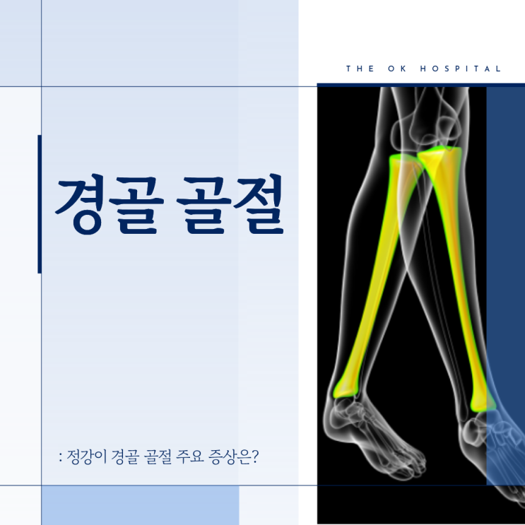  춘천 다리골절, 정강이 경골 골절 주요 증상은?