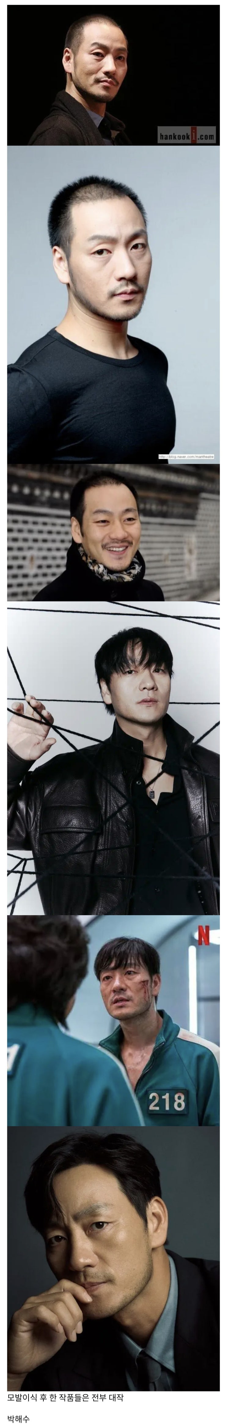  모발이식 후 초대박난 배우.jpg