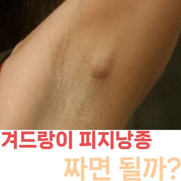 겨드랑이 피지낭종 원인·증상·치료법 총정리, '짜면 안 되는 이유와 병원 가야 할 신호'