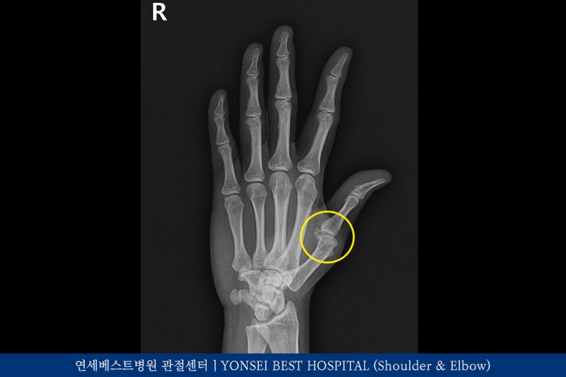 엄지손가락 통증, 척측 측부인대 수술
